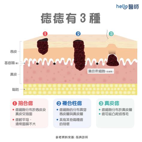 痣長毛原因|痣為什麼會長毛？探討痣與毛髮生長的關係